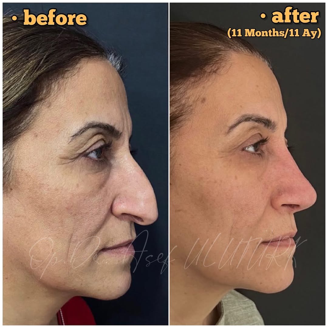 Затворена (безбелезна) ринопластика