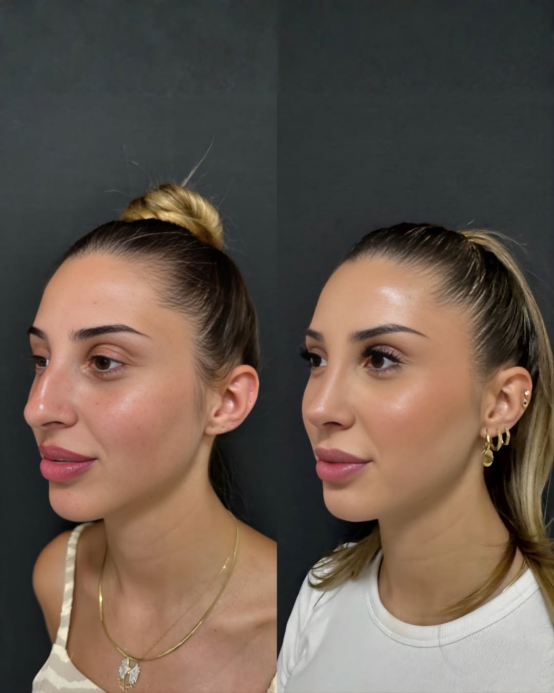 Затворена (безбелезна) ринопластика