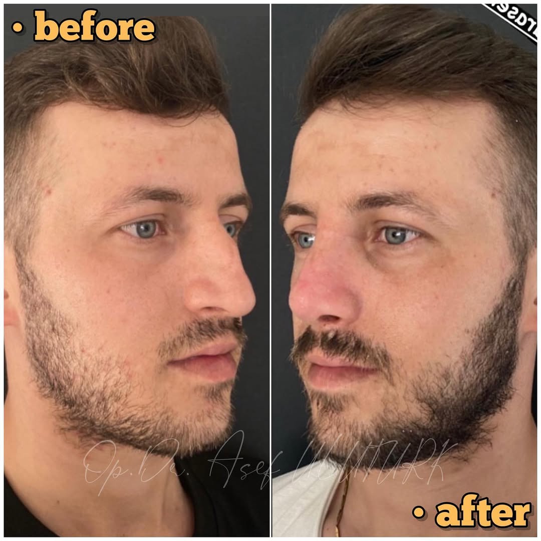 Затворена (безбелезна) ринопластика