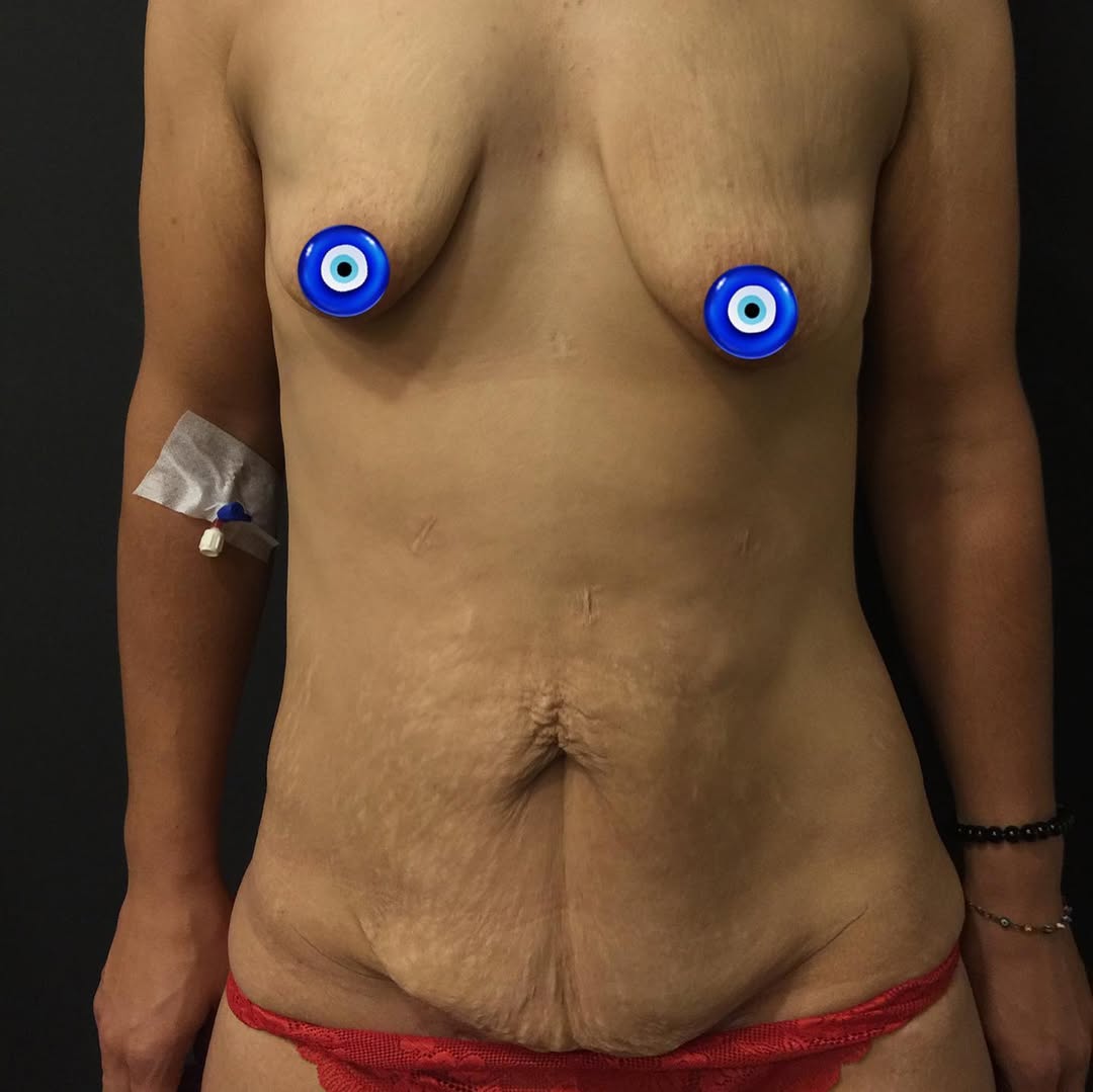 Естетика на гърдите и абдоминопластика