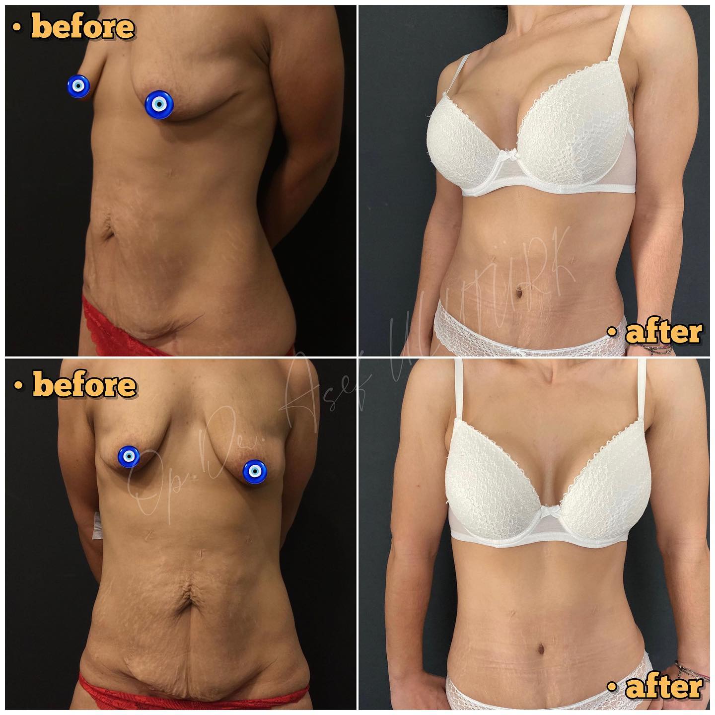 Естетика на гърдите и абдоминопластика