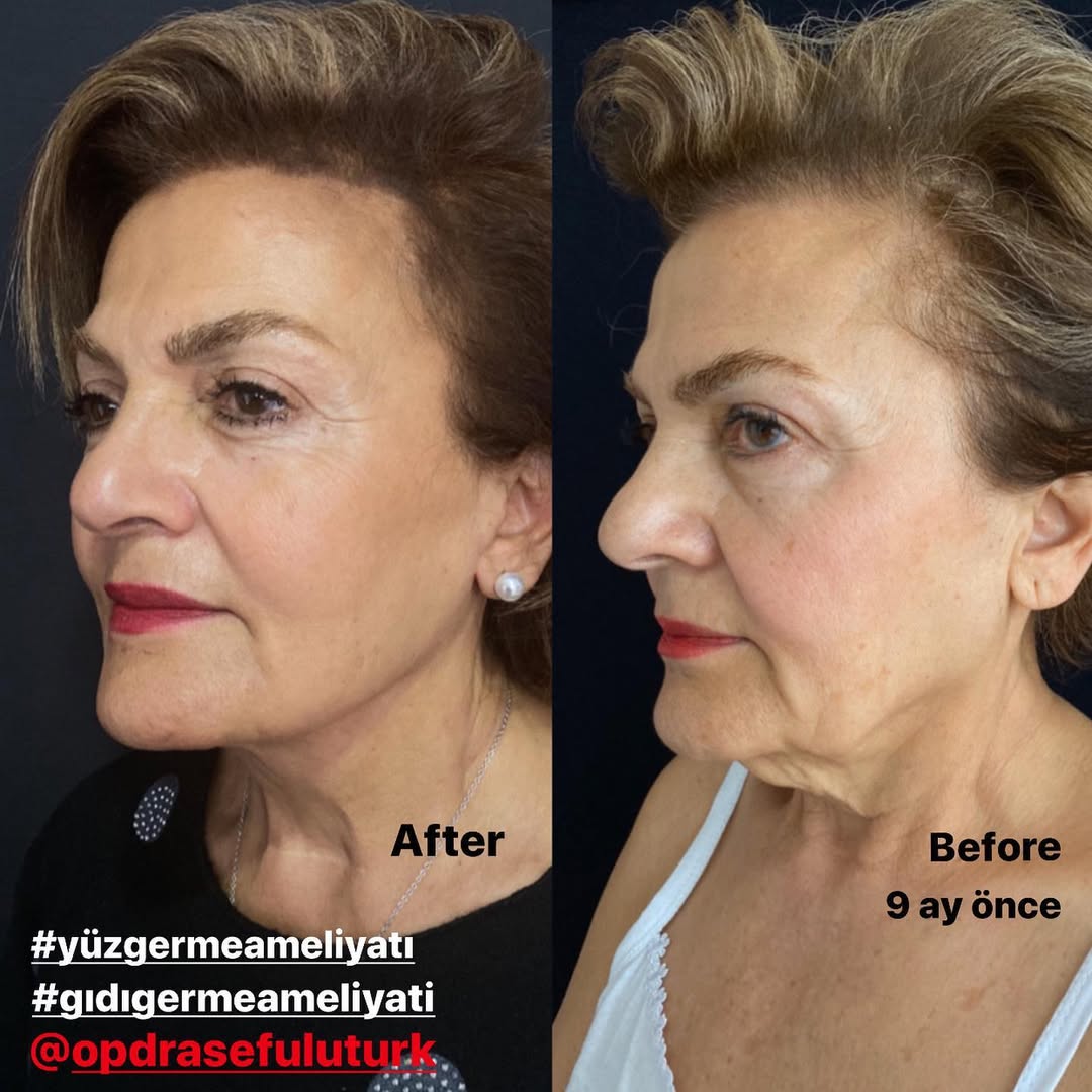 Подмладяване на лицето