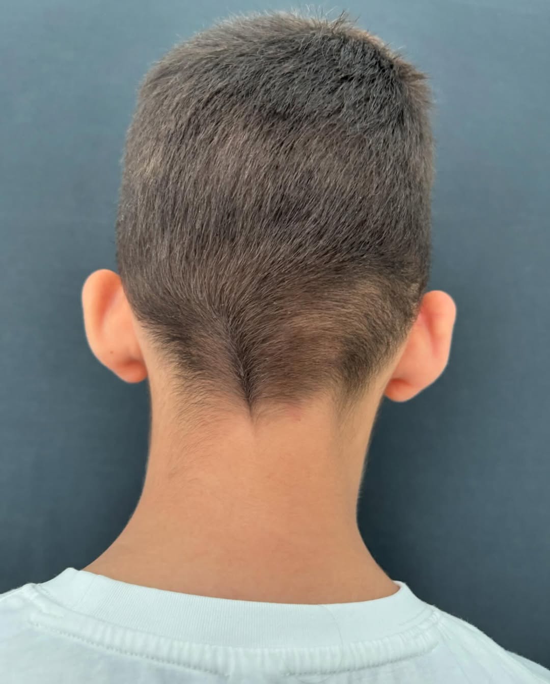 Отопластика