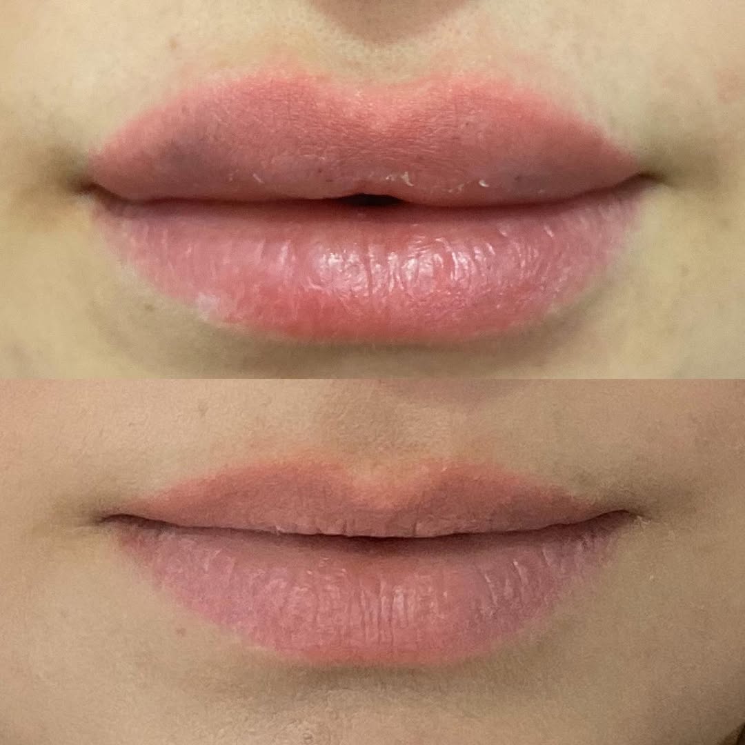 Филър за устни