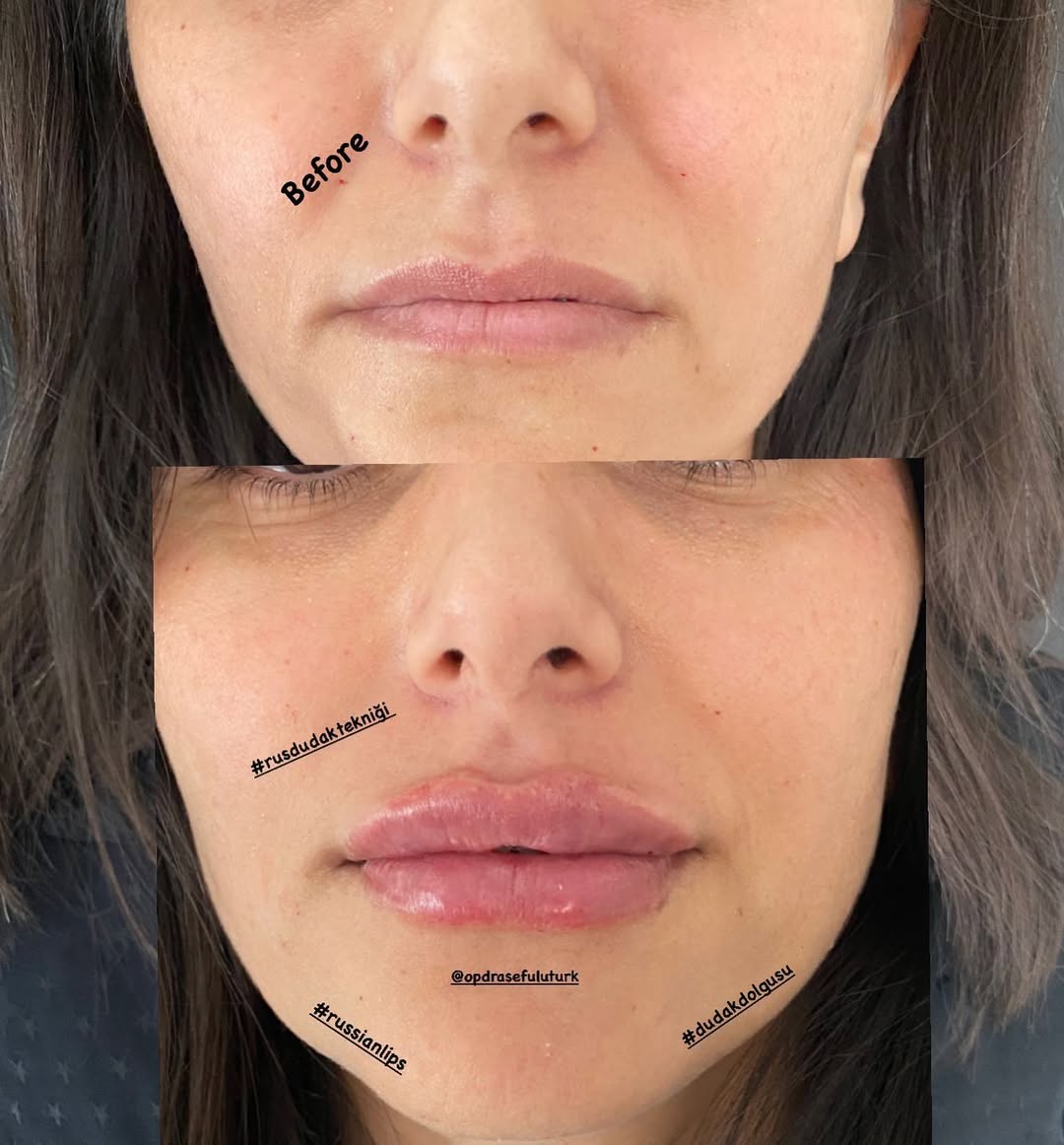 Филър за устни