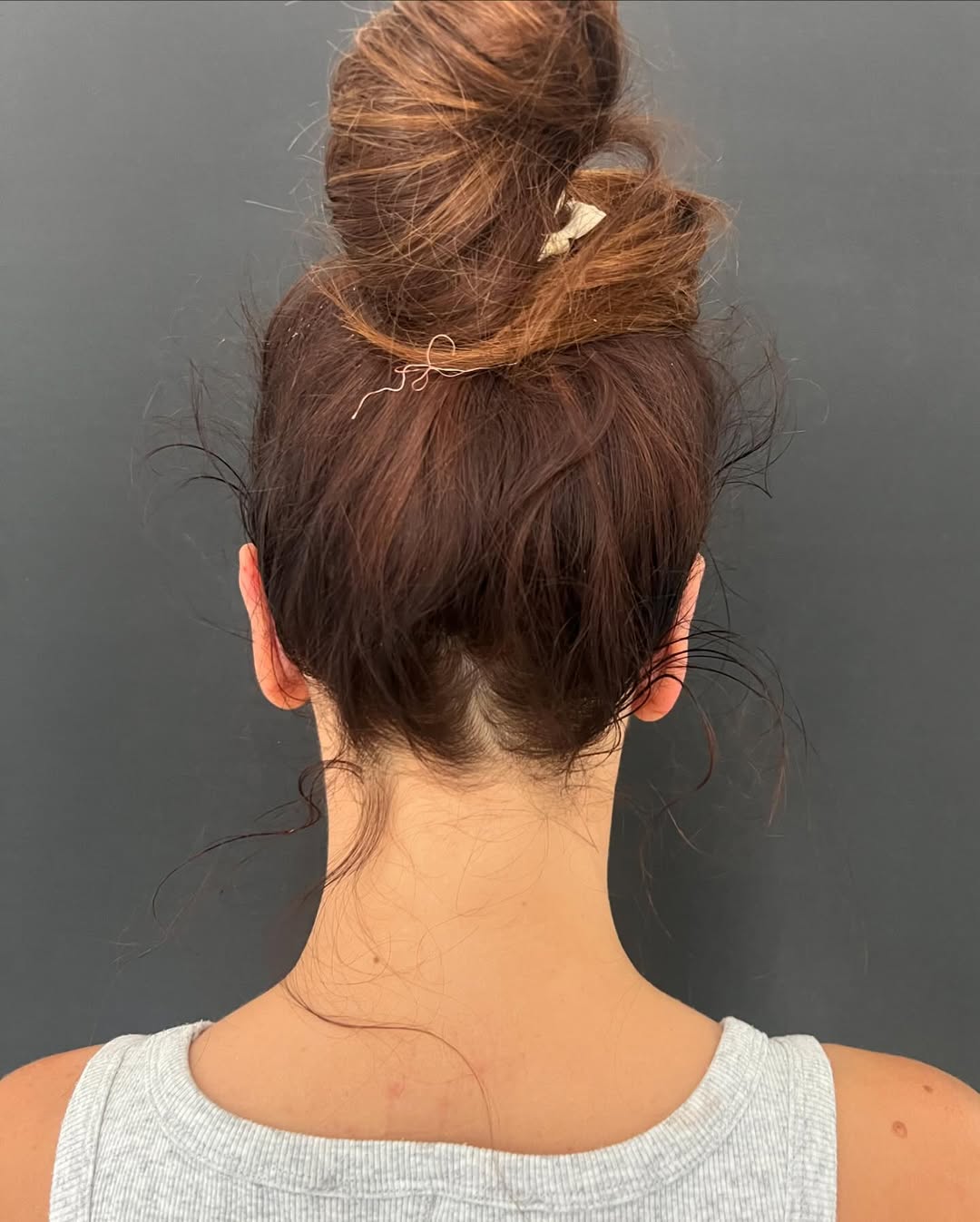 Отопластика