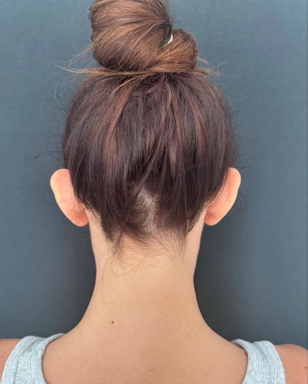 Отопластика