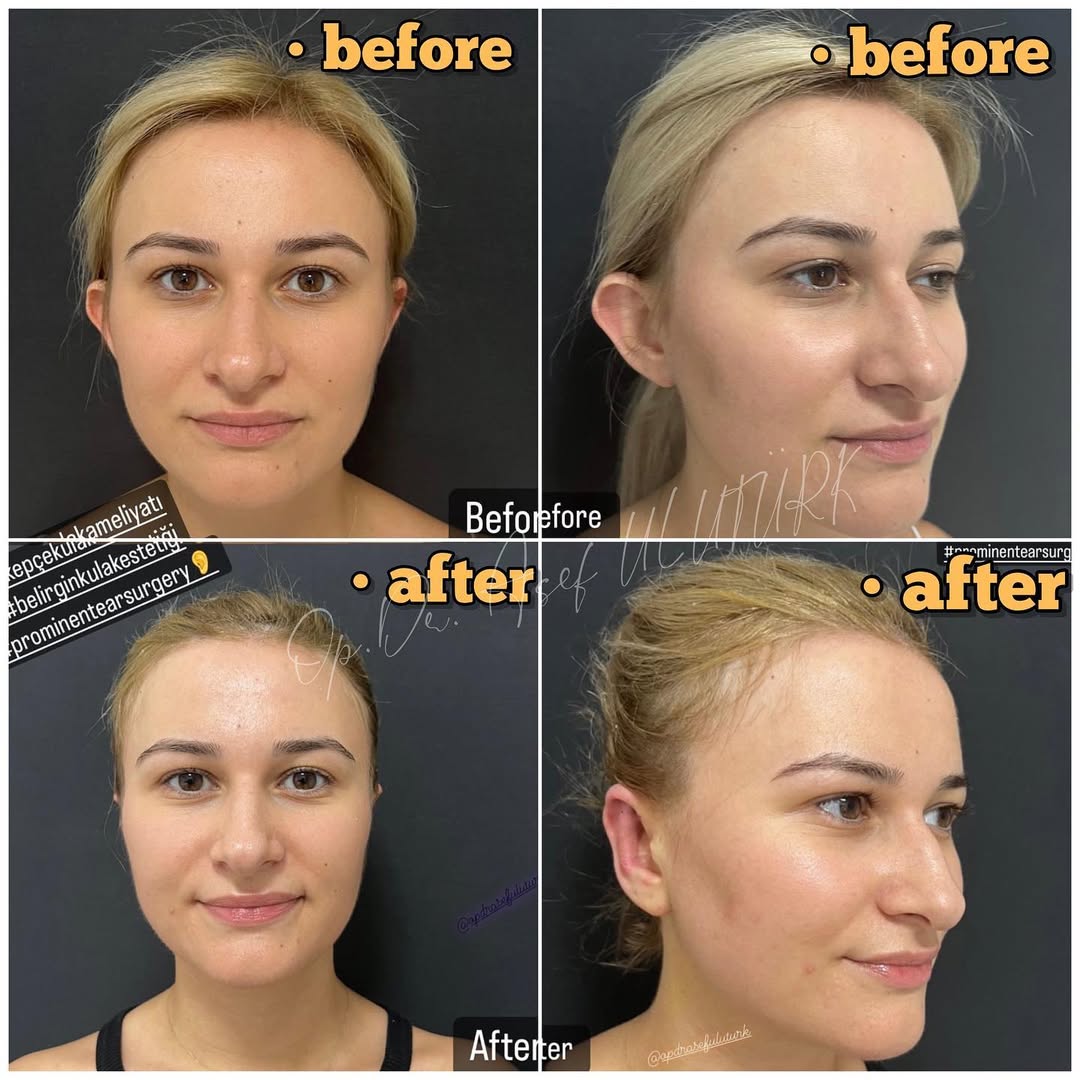 Отопластика