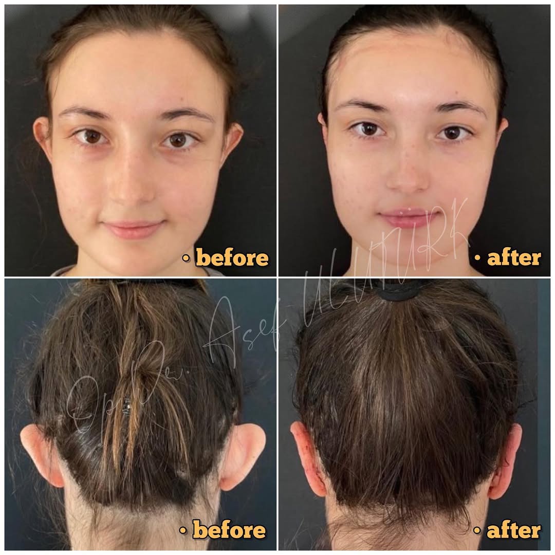 Отопластика